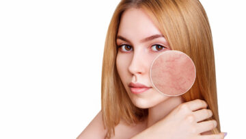 Rosacea: gerötete Haut besänftigen